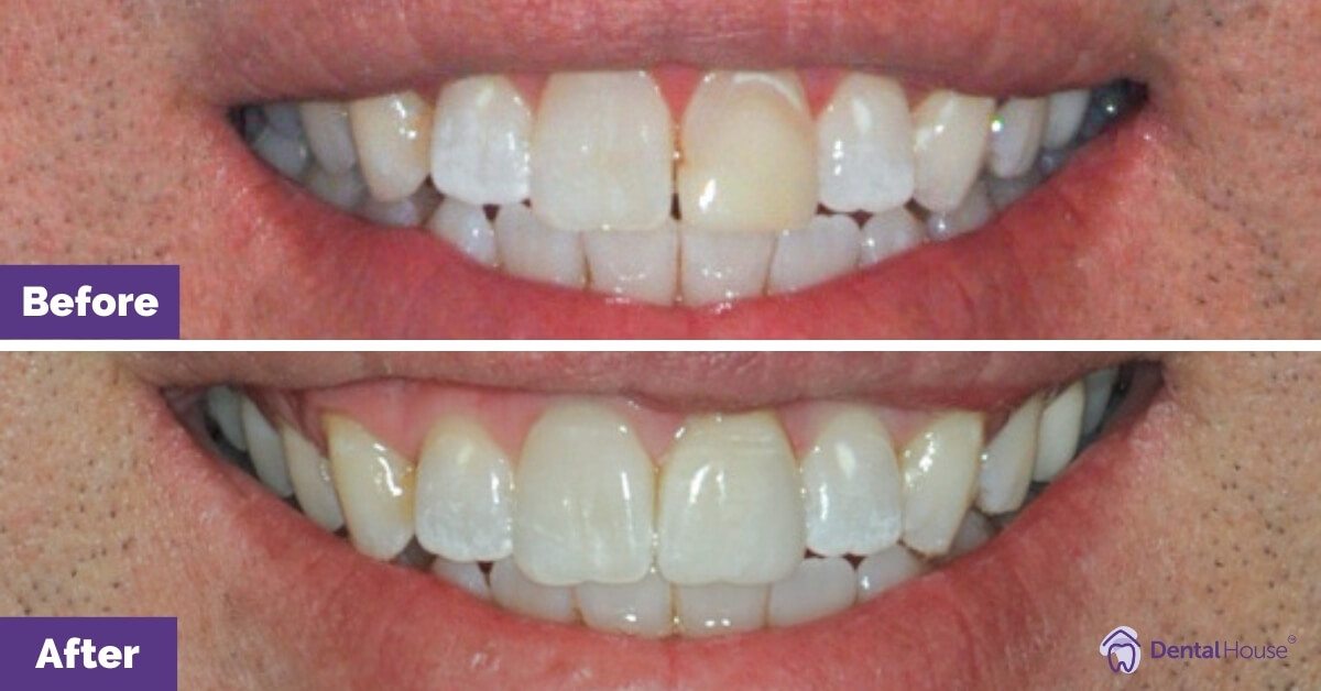 Dental-House-Group_Mitchell-Smile-Makeover-Journey