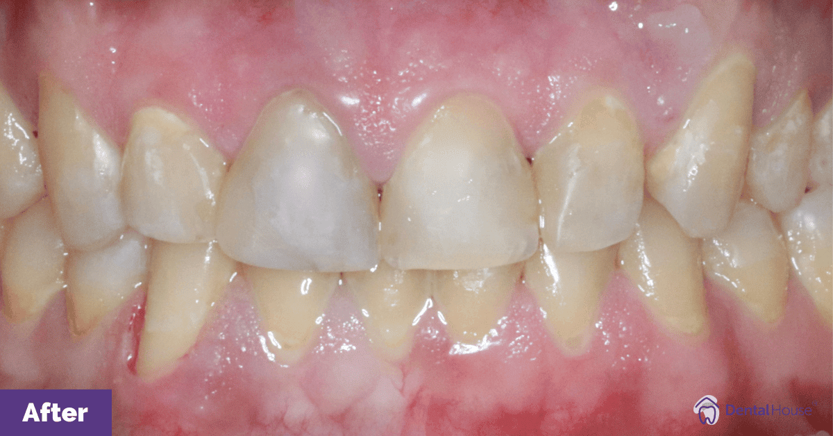 Grant-Root-Canal-Crown-Fillings-in-New-Gisborne-1-1