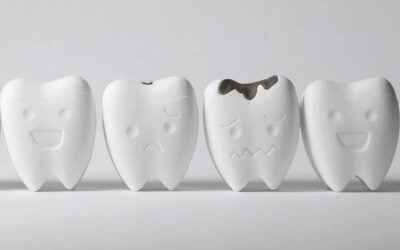 What’s New In Tooth Decay? Another Bacteria, That’s What
