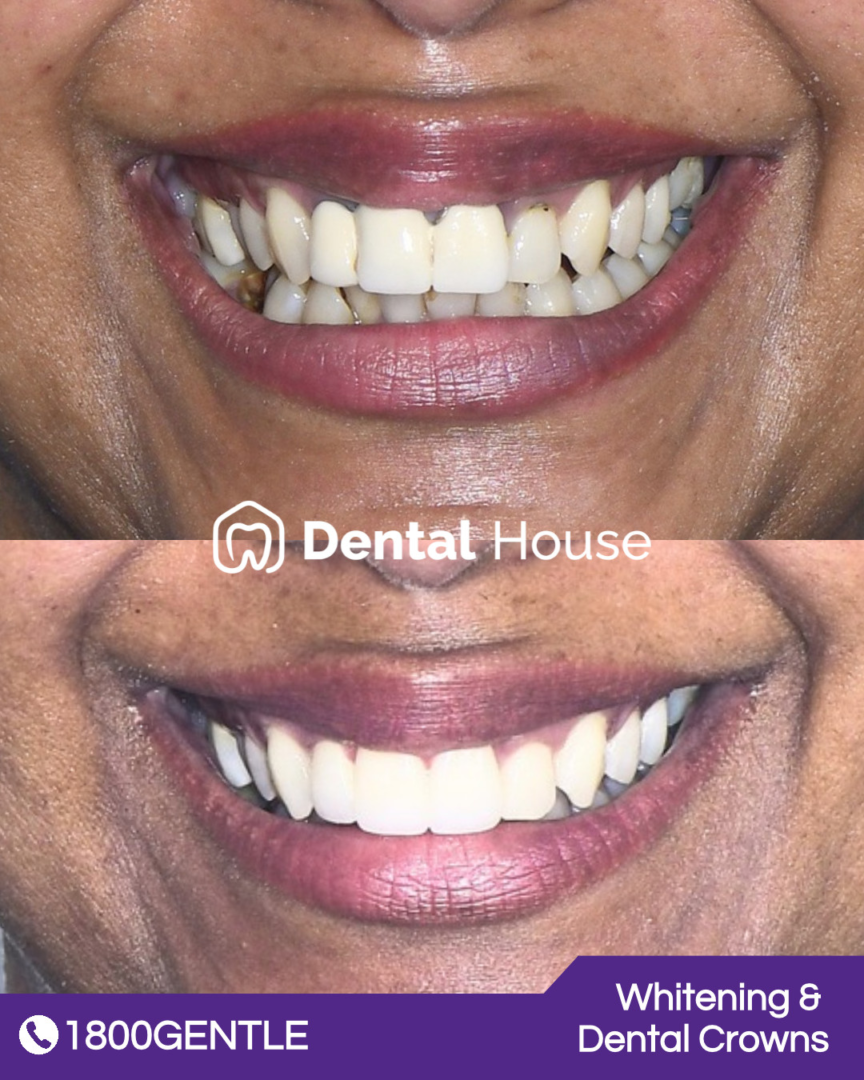 Teeth Whitening & Dental Crown