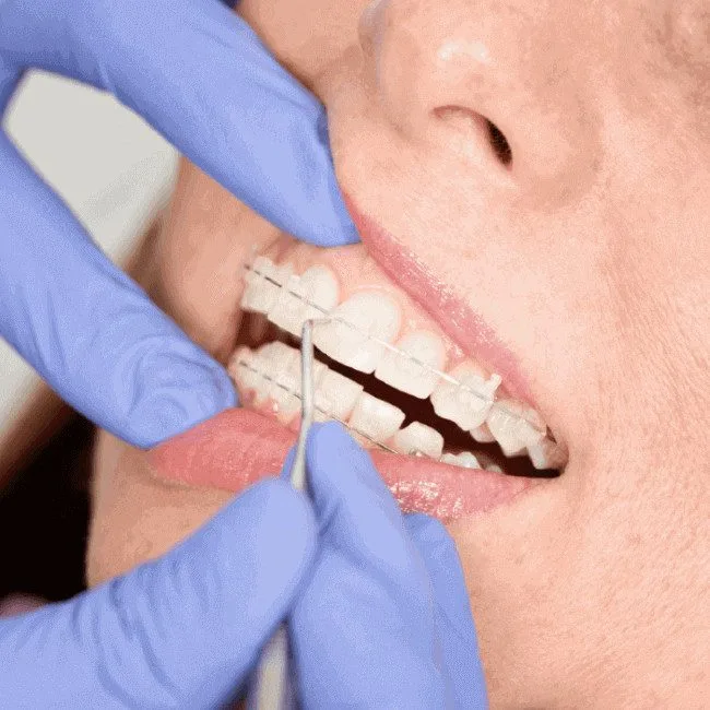 Braces Sunbury Melbourne North West Orthodontic Treatment Metal Ceramic Dentist