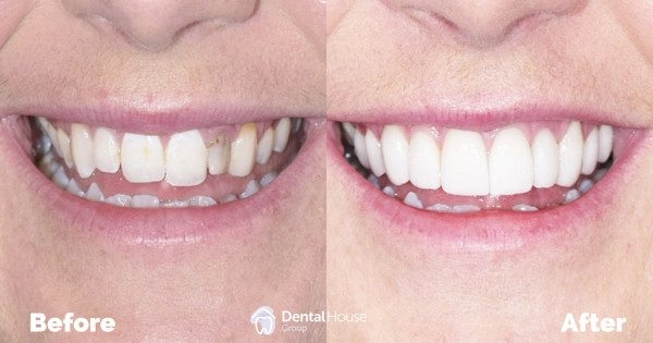 Combined Endodontic Aesthetic Treatment Clinical Case in Sunbury 1
