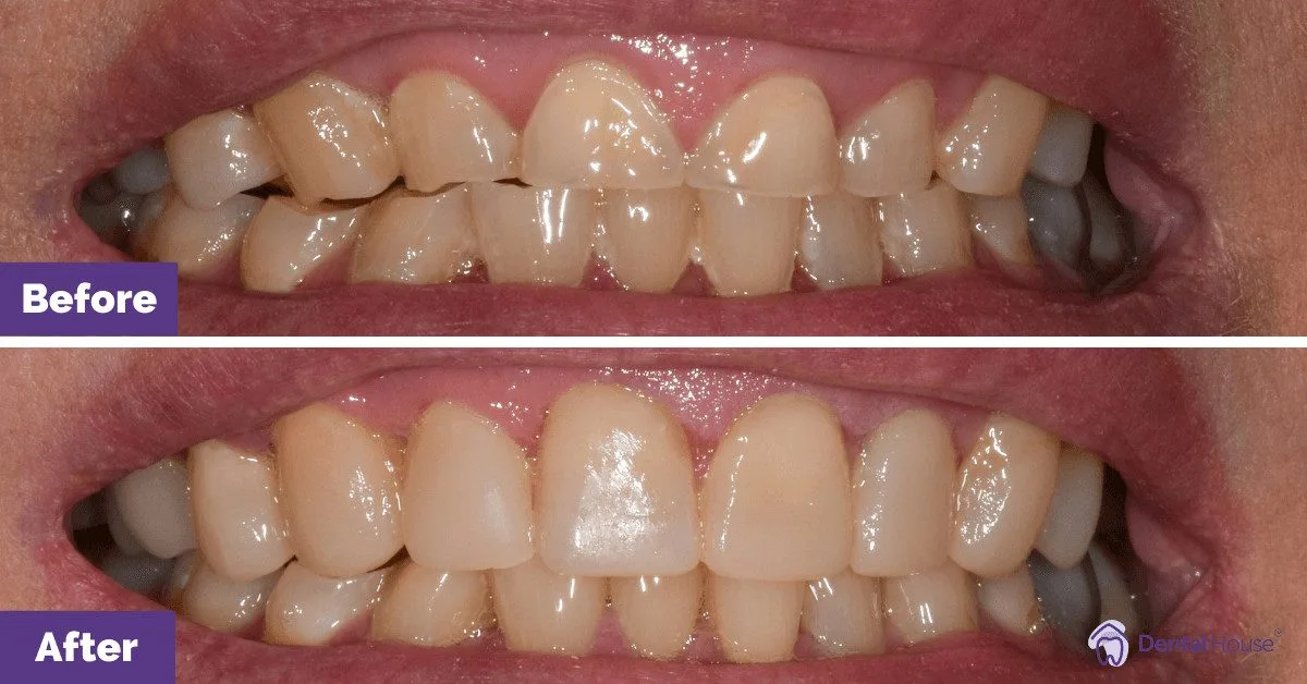 Composite Veneers in New Gisborne 1
