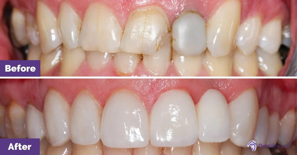 Dental House Group Sharon B Smile Makeover Journey