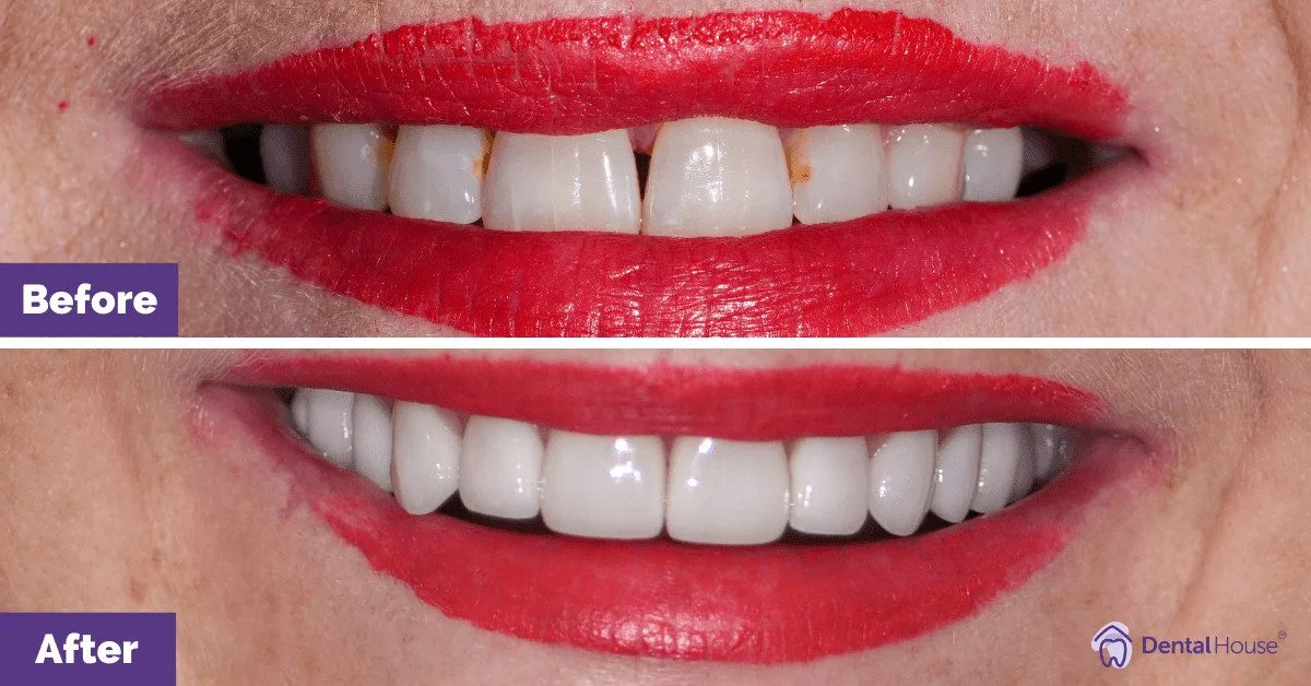 Dental Implant and Porcelain Veneers in Sunbury 3