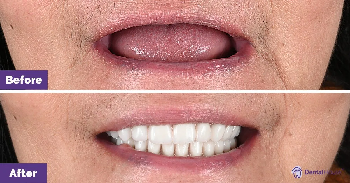 J Dental Implant in Sunbury BA
