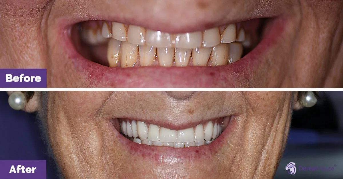 Kerry Porcelain Veneers Crowns 2