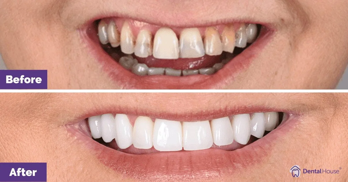 Q Porcelain Veneers in Sunbury 4