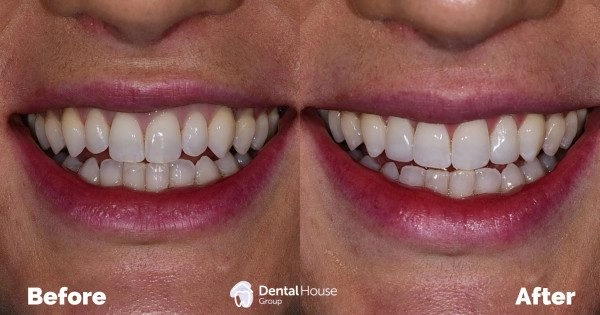 Staged Orthodontic Treatment Clinical Case in Sunbury 1