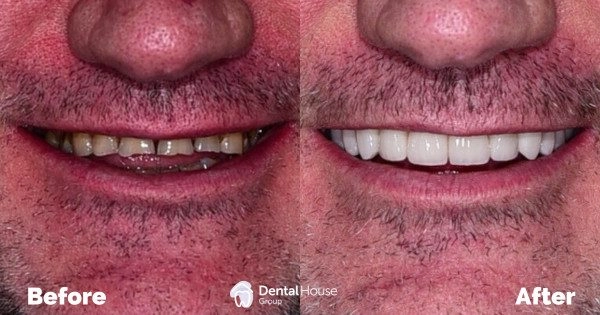 Staged Reconstructive Therapy Clinical Case in Sunbury 1